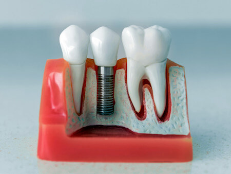 reduced-restaura-sorrisos-tratamentos-chamadasimplantes-dentarios